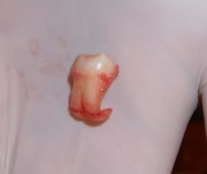 Wisdom tooth