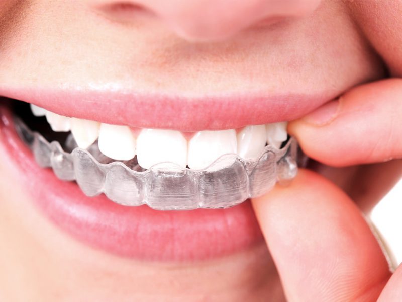 U.S based startup delivering clear aligners at home