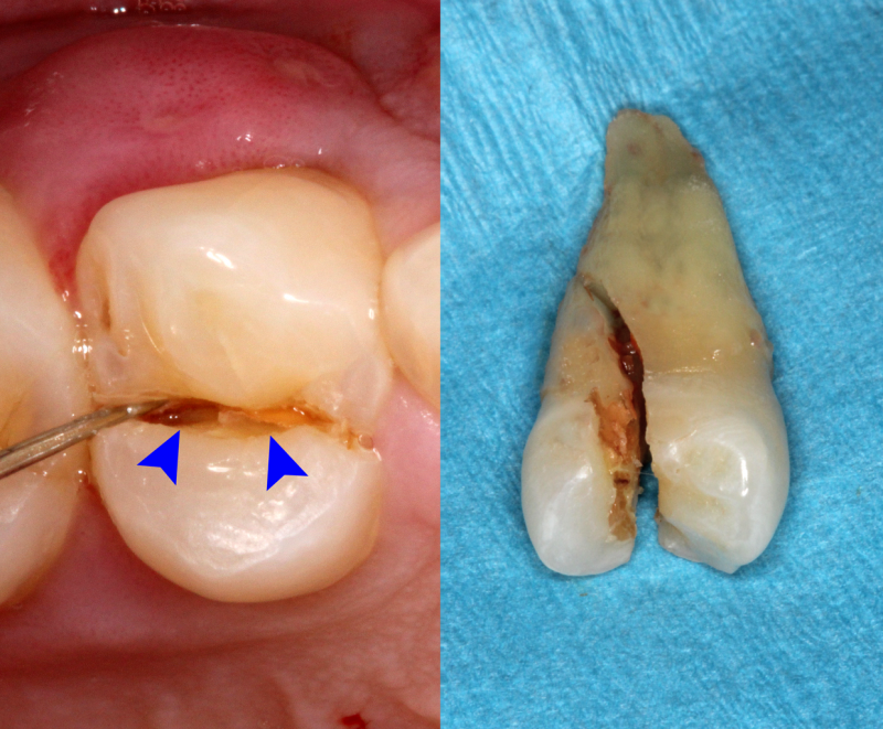Cracked Tooth Syndrome (CTS). Do you have one?