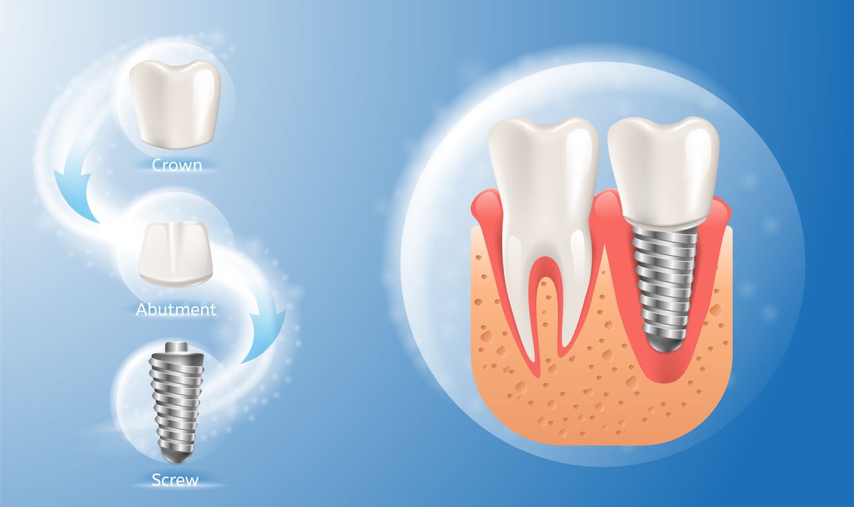 Dental Implant System – Know your Implant before getting one!
