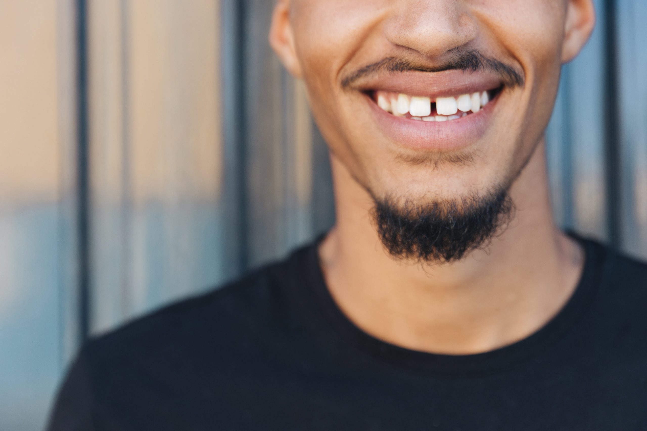 Mind That Space – Tips to Prevent Space Between Teeth
