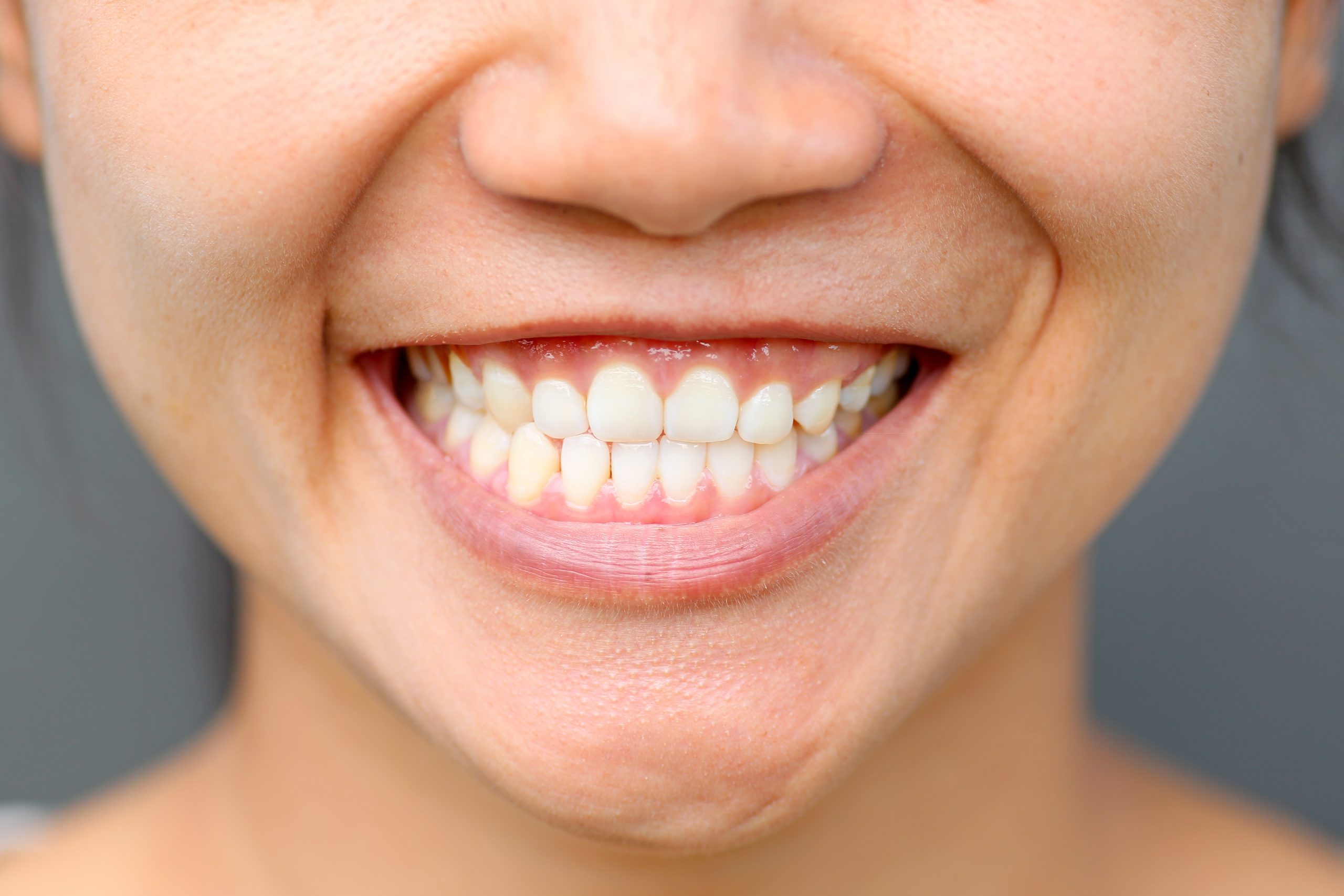 Gummy Smile? Sculpt your gums to get that stunning smile