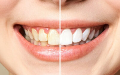 Teeth whitening