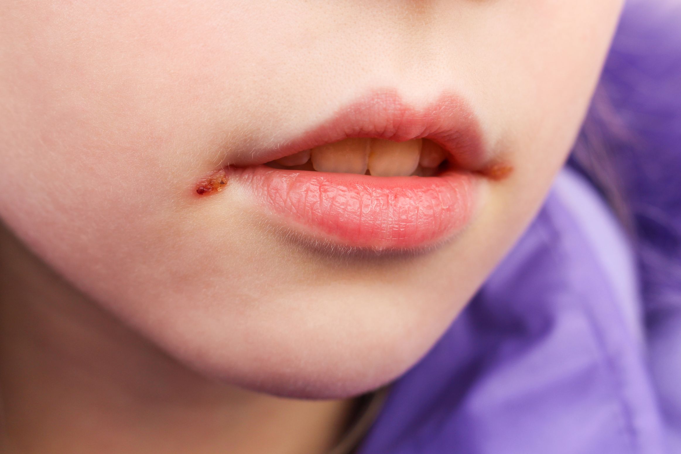Are the corners of your lips always dry?