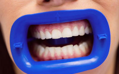 Everything you need to know about Gum Surgery