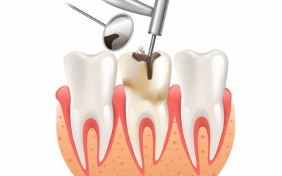 Dental filling