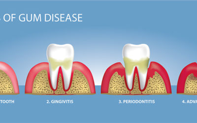 Gum diseases: what you need to know