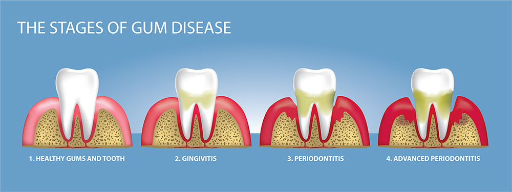 types-of-gum-diseases-dental-blog-dental-dost