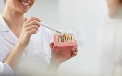 Dental implants for missing teeth
