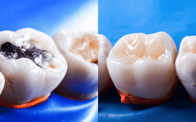 Tooth fillings: White is the new silver