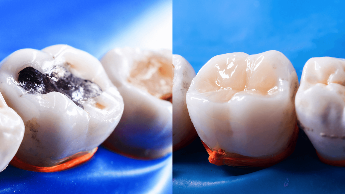 Before and after composite