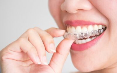 Clear Aligners, what’s the buzz about?