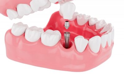 Same-day tooth extraction, same-day dental implants