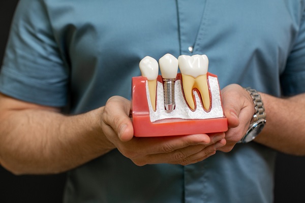 Why are dental implants so expensive?