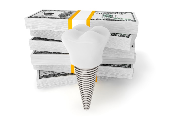 Reasons for cost variation in dental implants