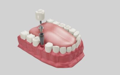 Debunking myths about Dental Implants