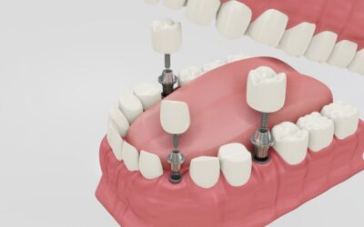 Different types of dental implants you should know
