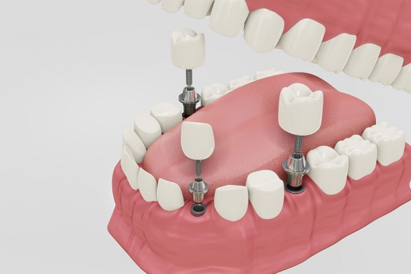 Different types of dental implants you should know
