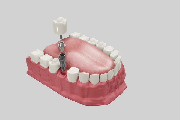 dental-implants-treatment-procedure-medically-accurate-3d-illustration-dentures