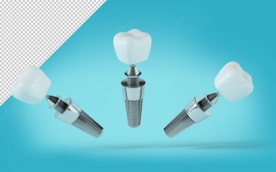Dental implants for multiple missing teeth