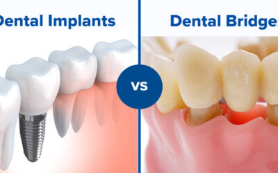 Dental bridge or an Implant- Which is better?