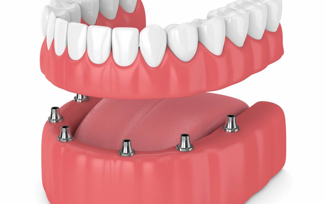 Implant and dentures together?