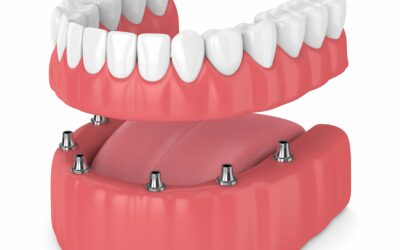 Implant and dentures together?