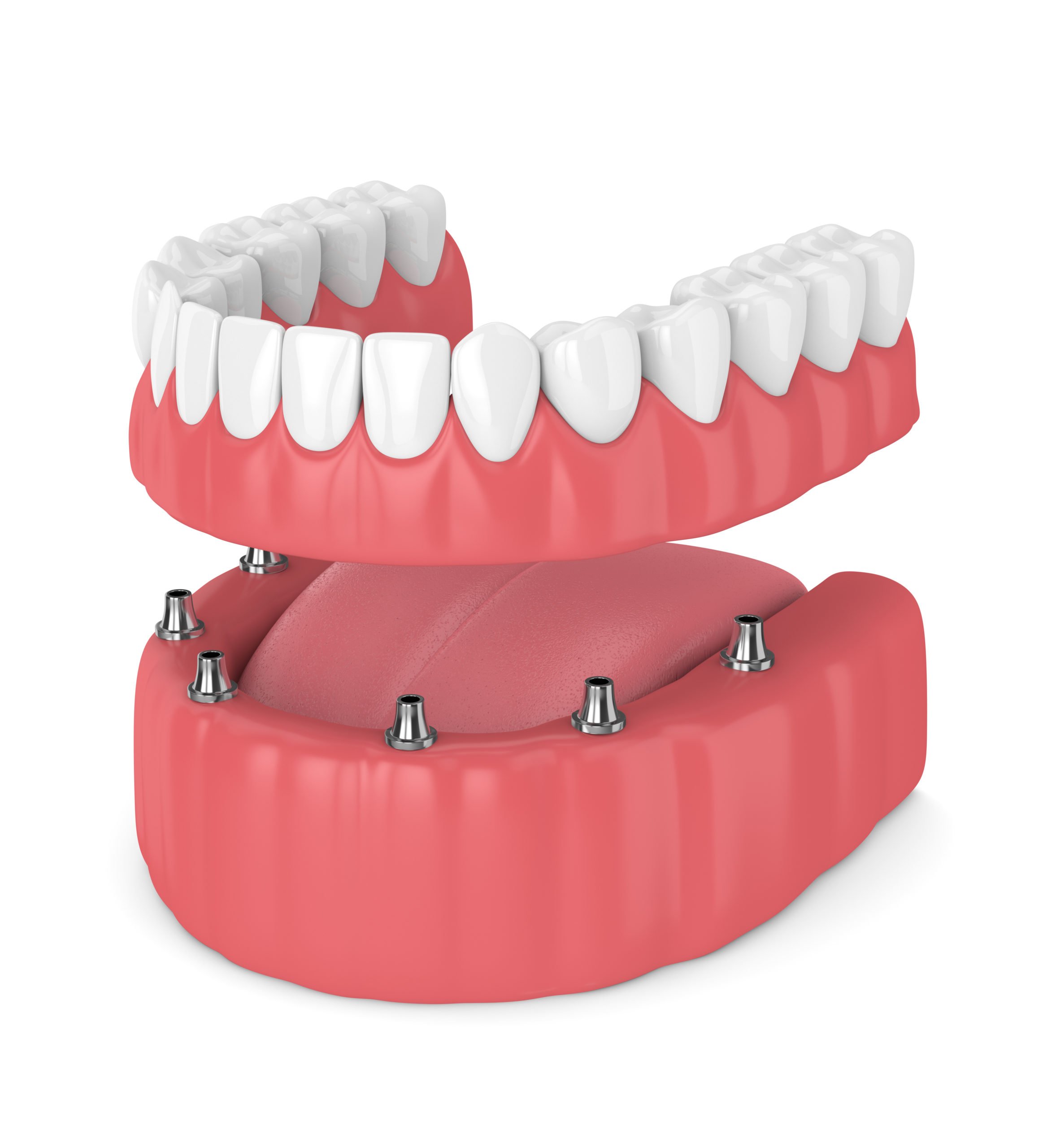 fixed-implant-denture_NewMouth-implant and denture