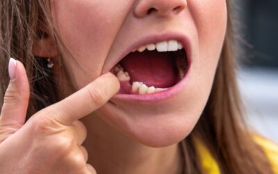 Missing Teeth Affecting Confidence? Consider Implants