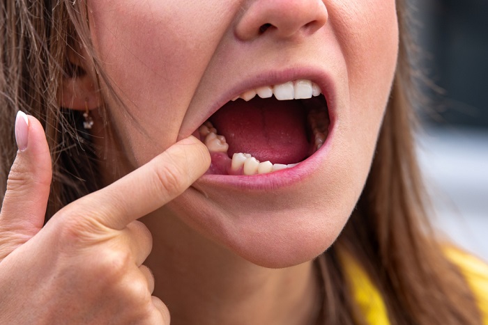 My Missing Teeth Affect My Confidence- Do I need Dental Implants