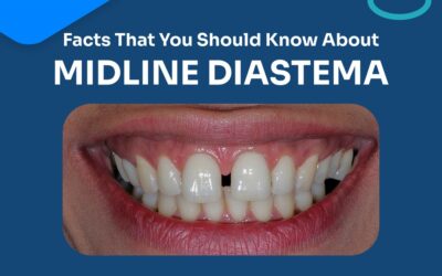Everything you need to know about Midline Diastema