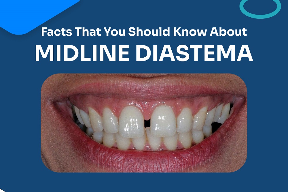 Ten Important Facts That You Should Know About Midline Diastema