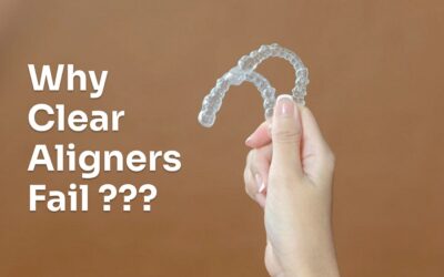 Reasons why clear aligners fail