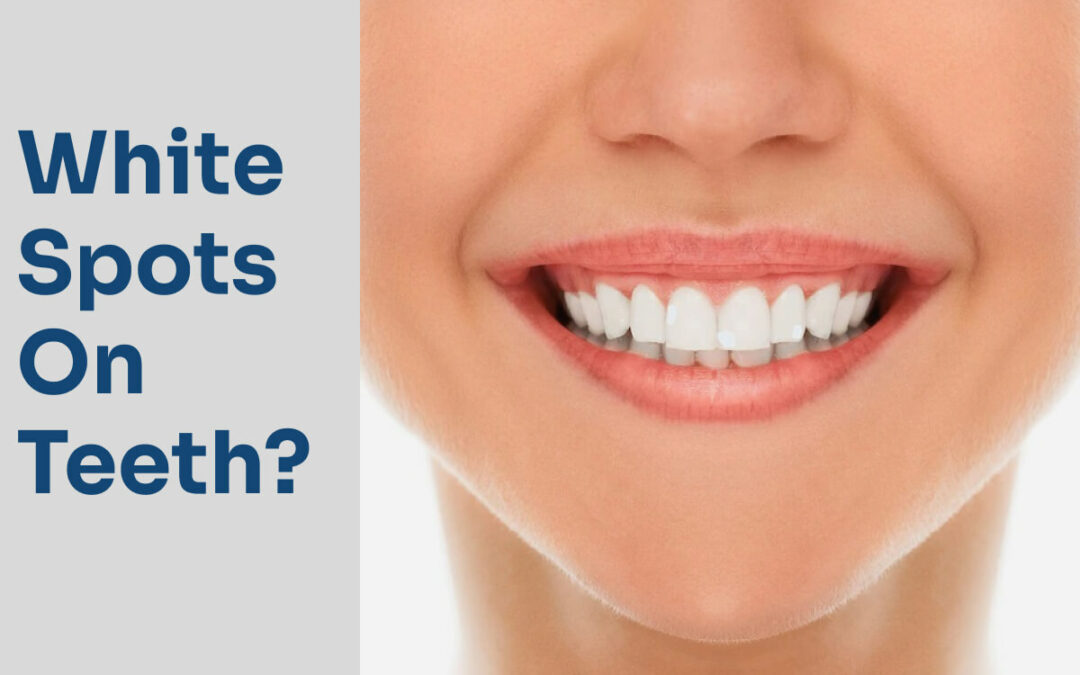 What Causes White Spots Teeth?