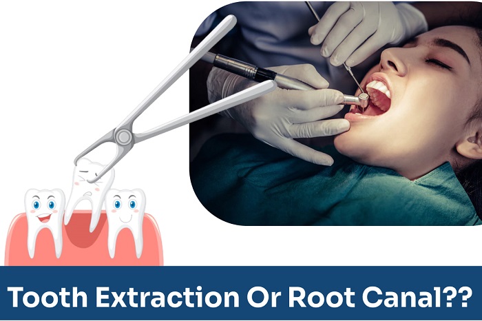 Which is better tooth extraction or root canal