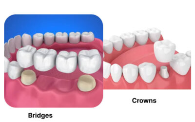 Bridges & Crowns: A Reliable Way to Restore Your Smile