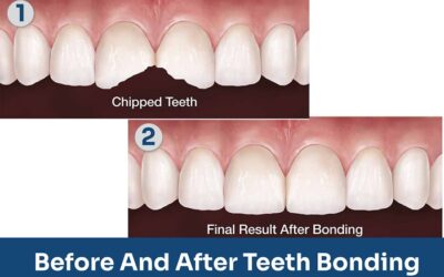 Why do you need teeth bonding?