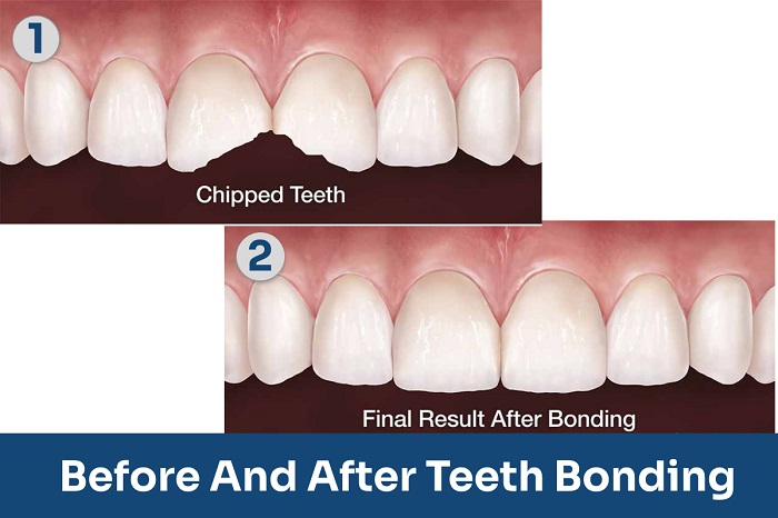 Why do you need teeth bonding
