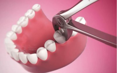Wisdom tooth removal