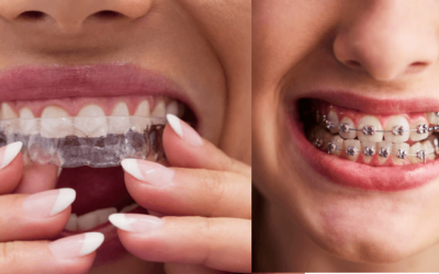 Braces vs. Invisalign: Which Option is Right for You?