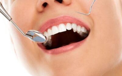 Smile Makeover