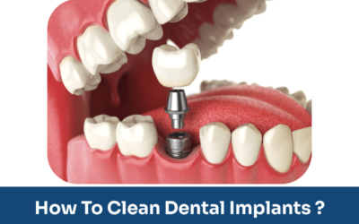 Tips to clean and maintain your dental implants