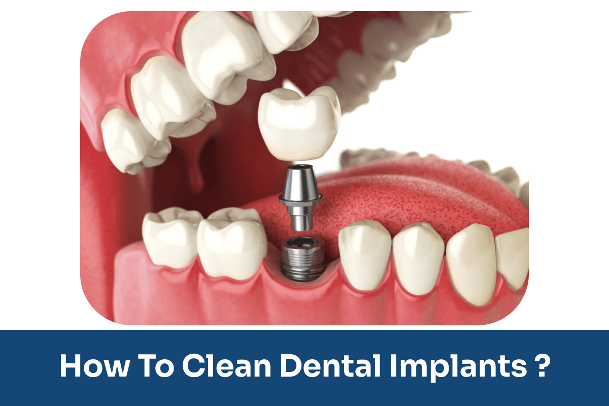 how to clean dental implants