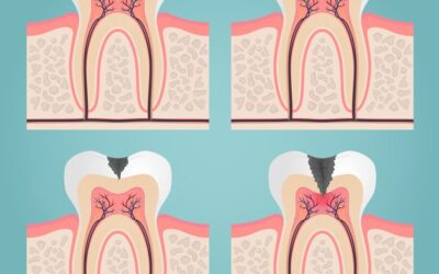 Root Canal Pain: Soothe Your Discomfort