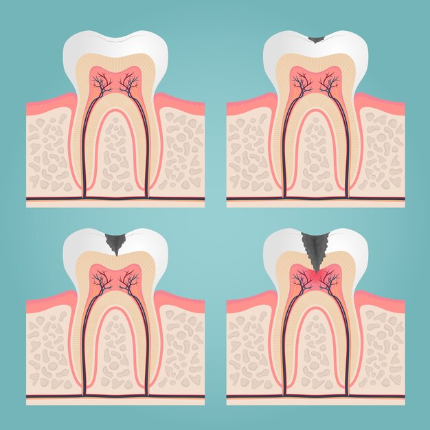 Root Canal Pain: Soothe Your Discomfort