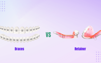 Braces vs Retainers: Choose the Right Option