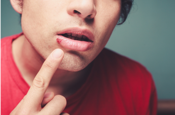 Cold sores: Causes, Prevention and Remedies