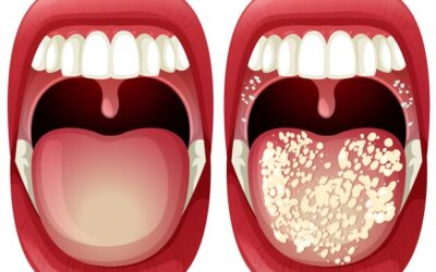 Mouth Ulcers : Types, Causes, Precautions